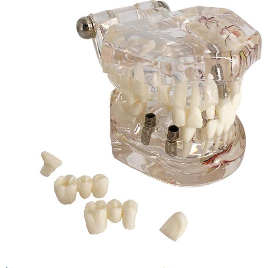 Modelo Dental Acrílico YOUYA para Enseñanza 9.4x6.6 cm