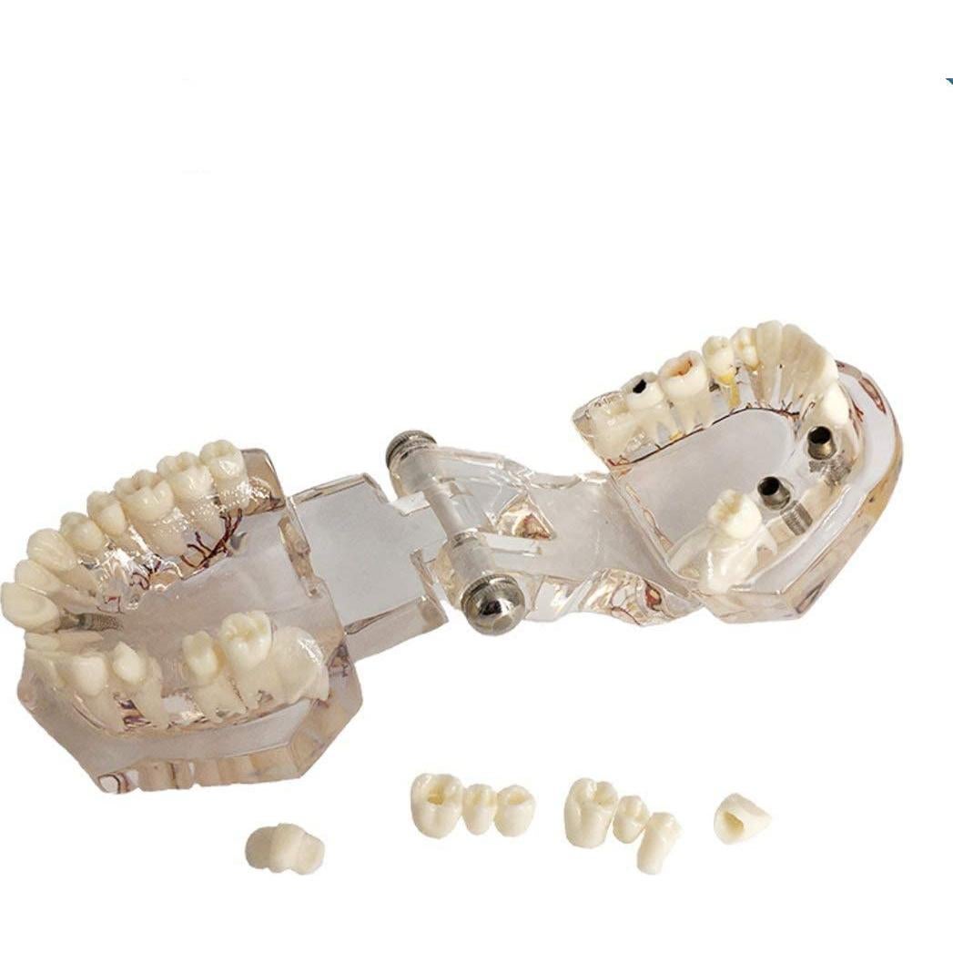 Modelo Dental Acrílico YOUYA para Enseñanza 9.4x6.6 cm