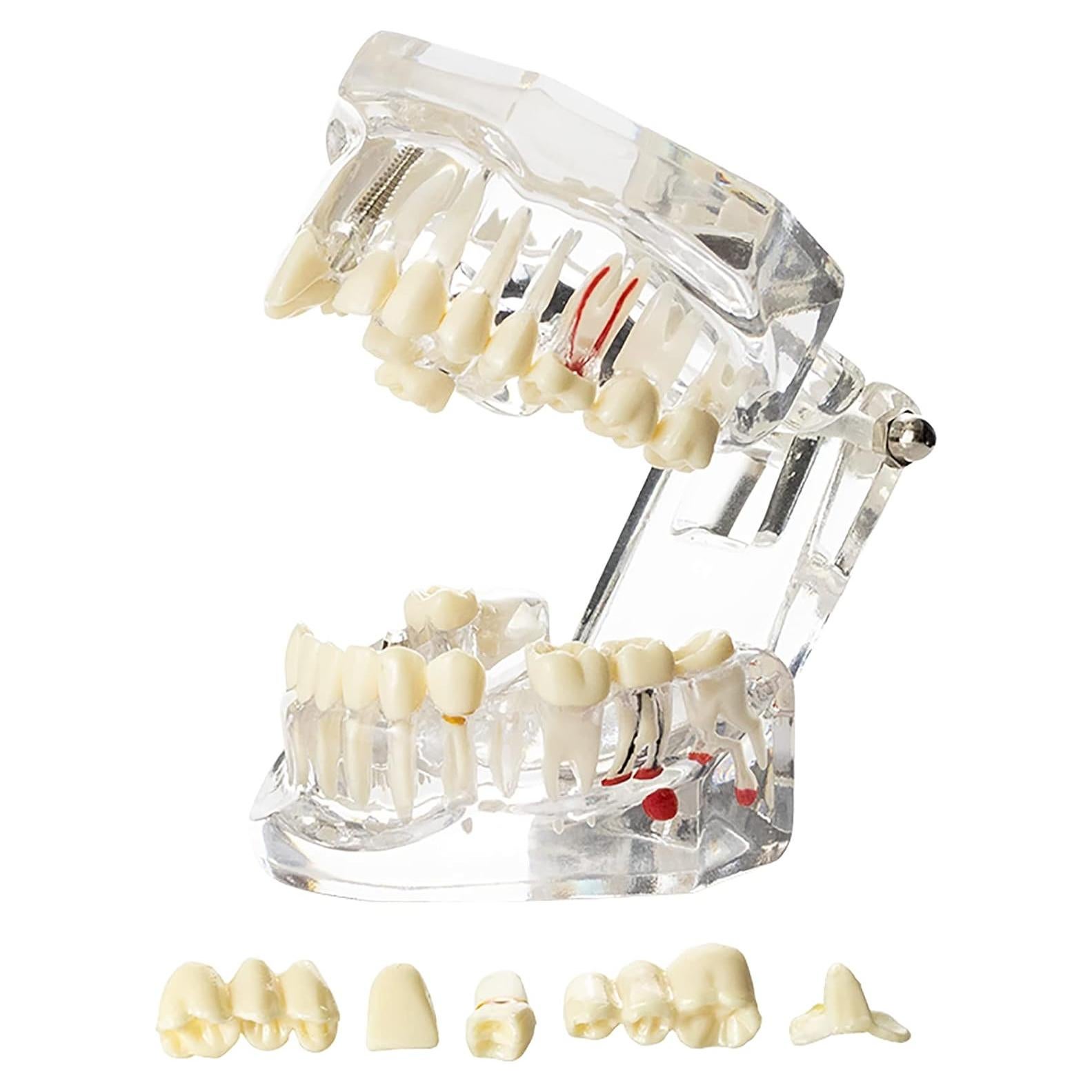 Modelo Dental Typodont Implantológico Dentalmall 2001C