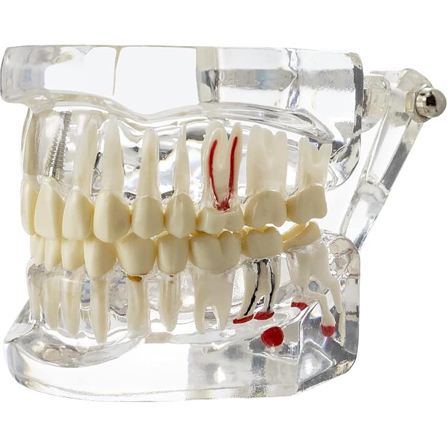 Modelo Dental Typodont Implantológico Dentalmall 2001C