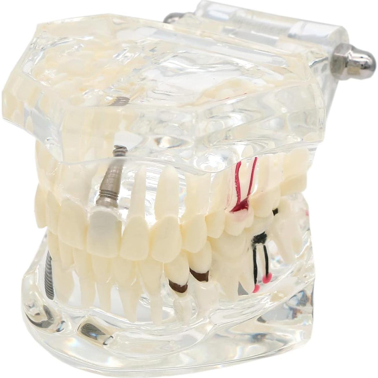 Modelo Dental Typodont Implantológico Dentalmall 2001C