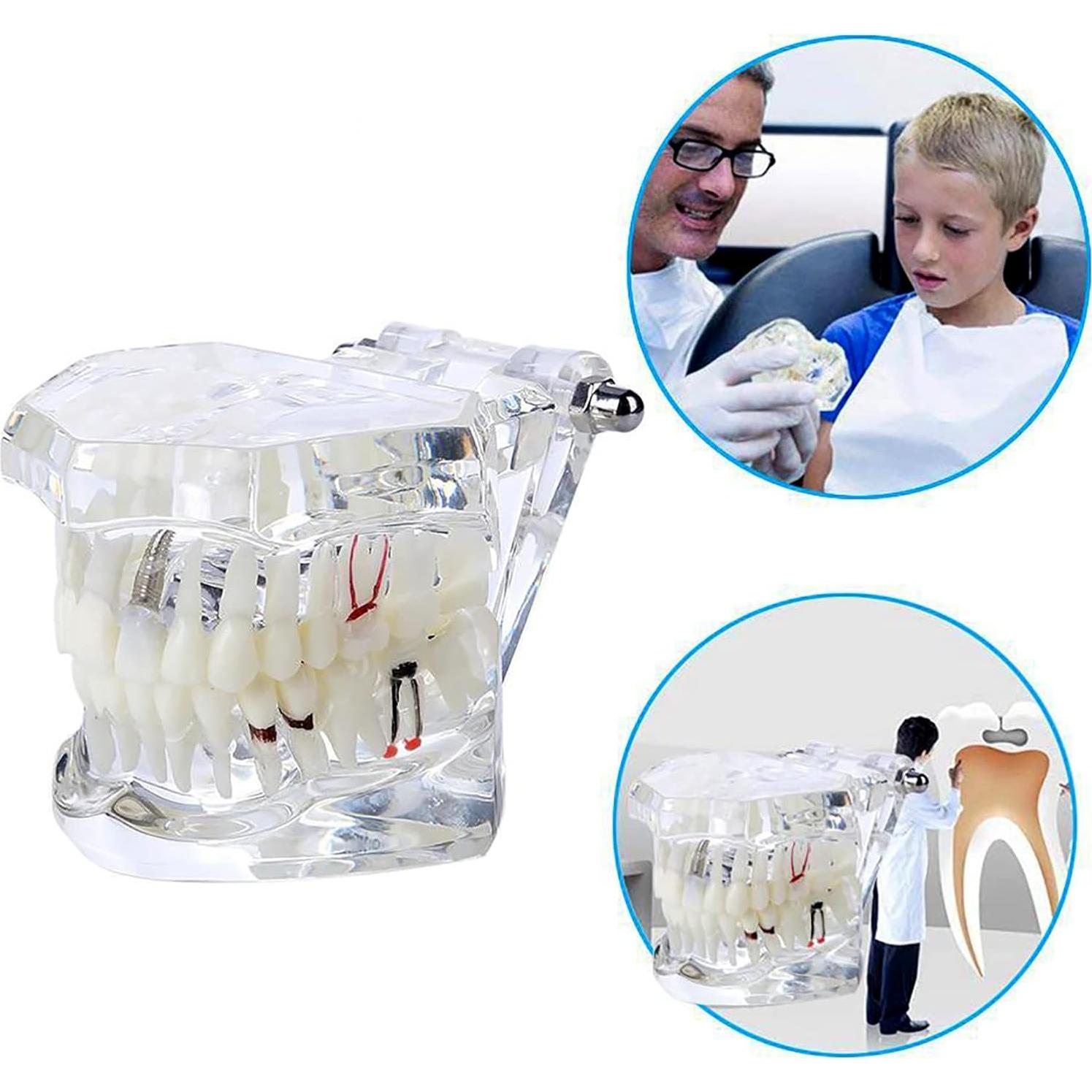 Modelo Dental Typodont Implantológico Dentalmall 2001C