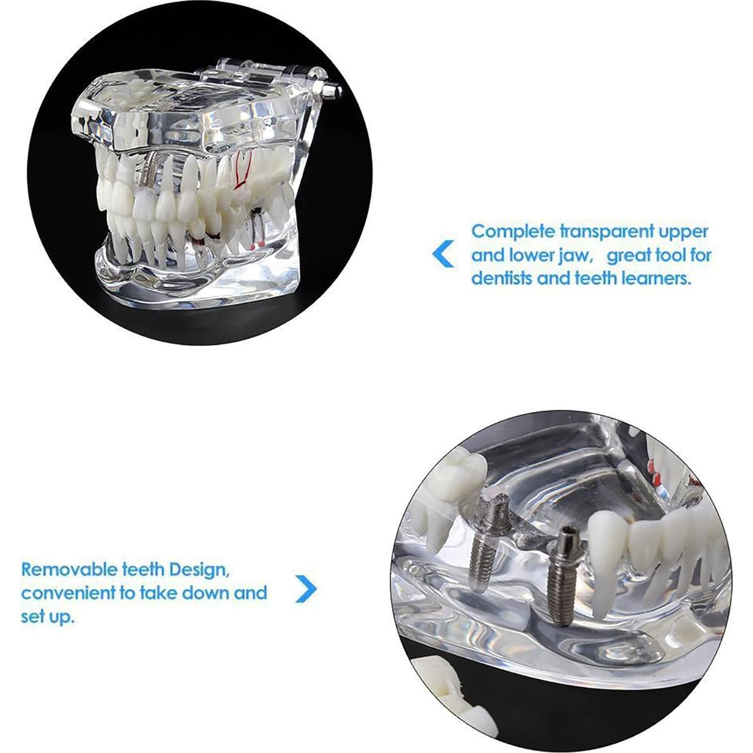 Modelo Dental Typodont Implantológico Dentalmall 2001C