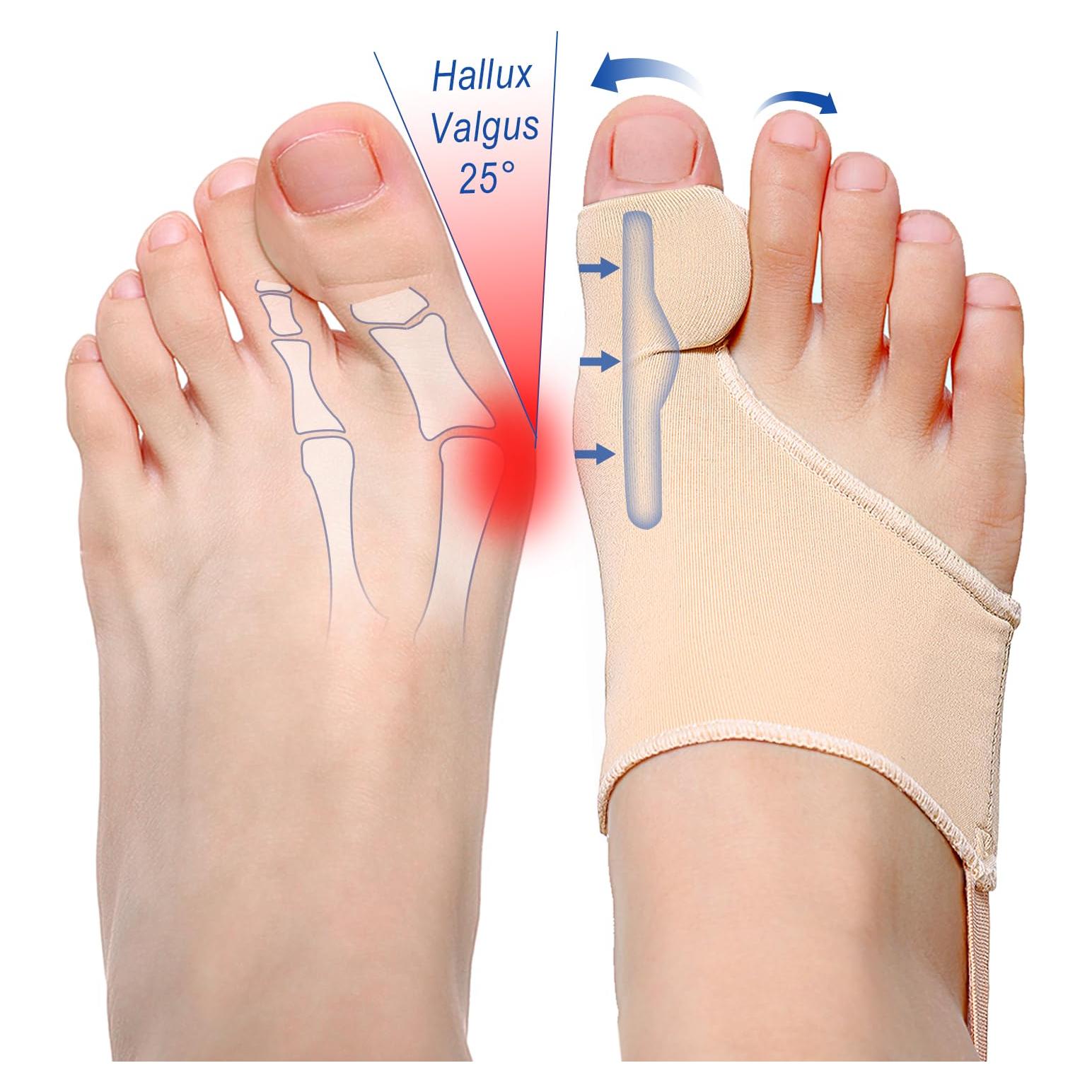 Corrector de Juanetes ELFON - Férula Ortopédica para Alivio