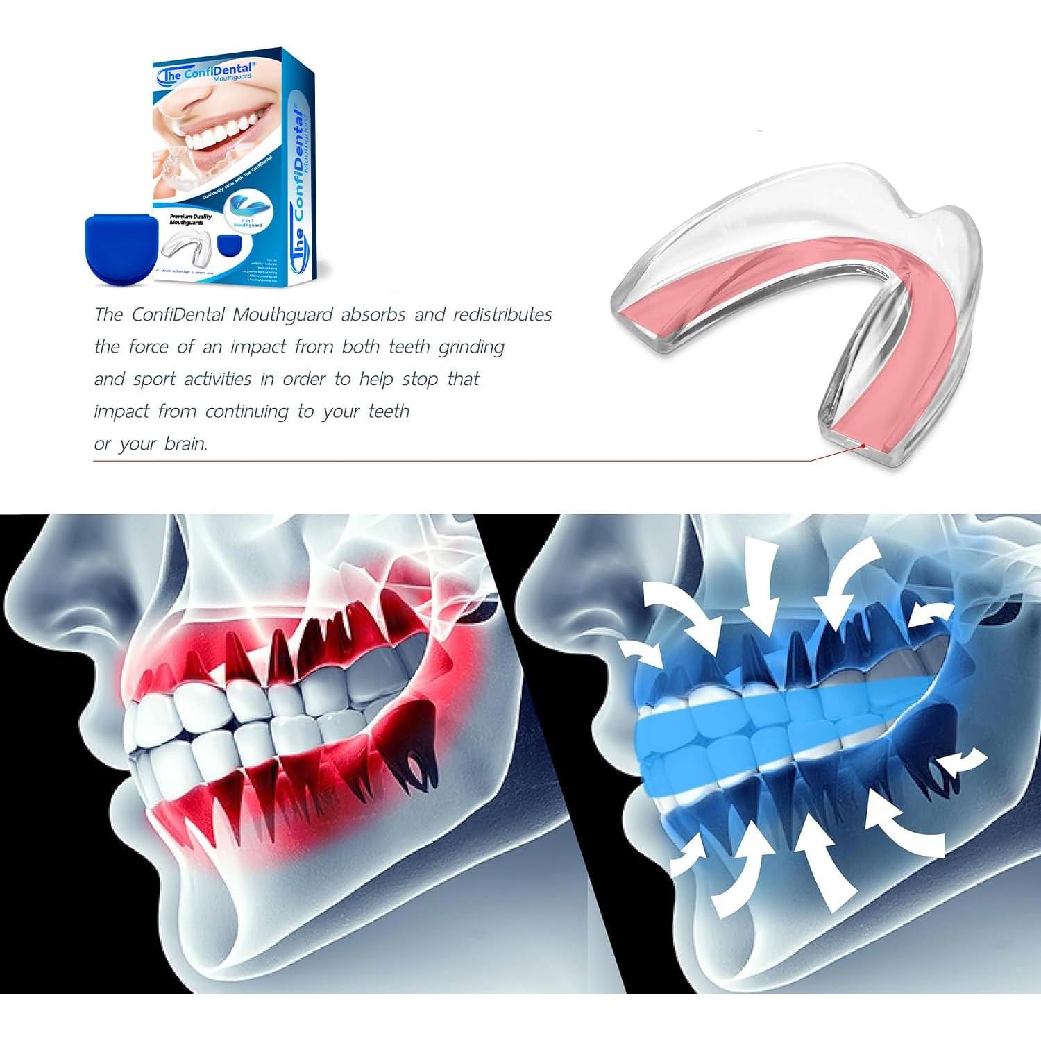 Paquete de 3 Protectores Bucales Moldables ConfiDental