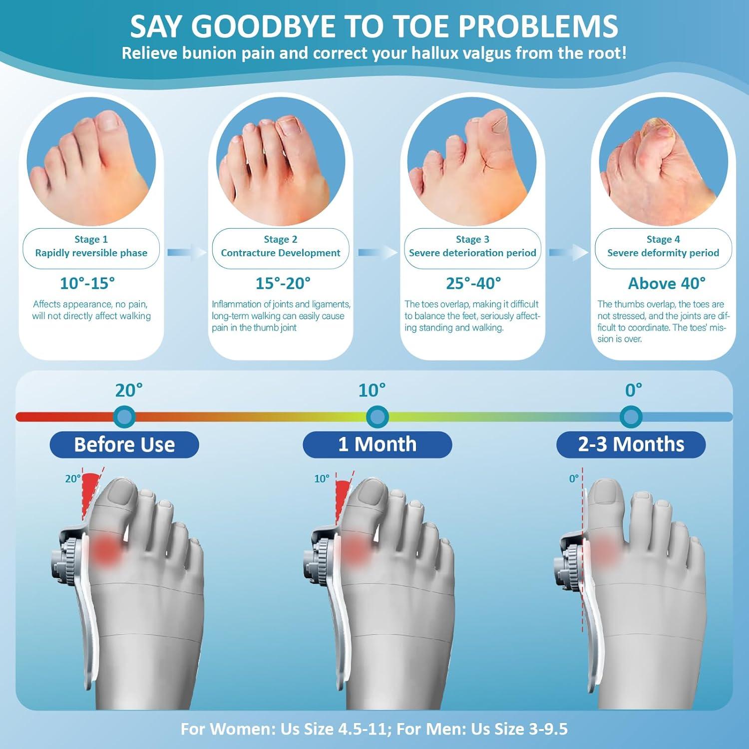 Corrector de Juanetes Ajustable Mejorado para Alivio - 1 Pieza