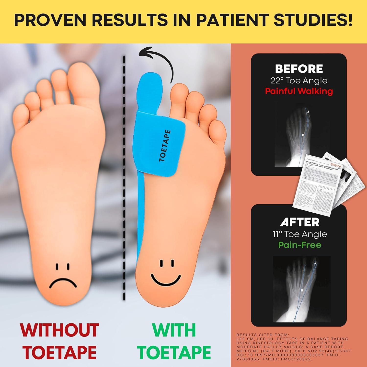 Cinta Kinesiológica ToeTape para Juanetes - 40 Tiras Azul