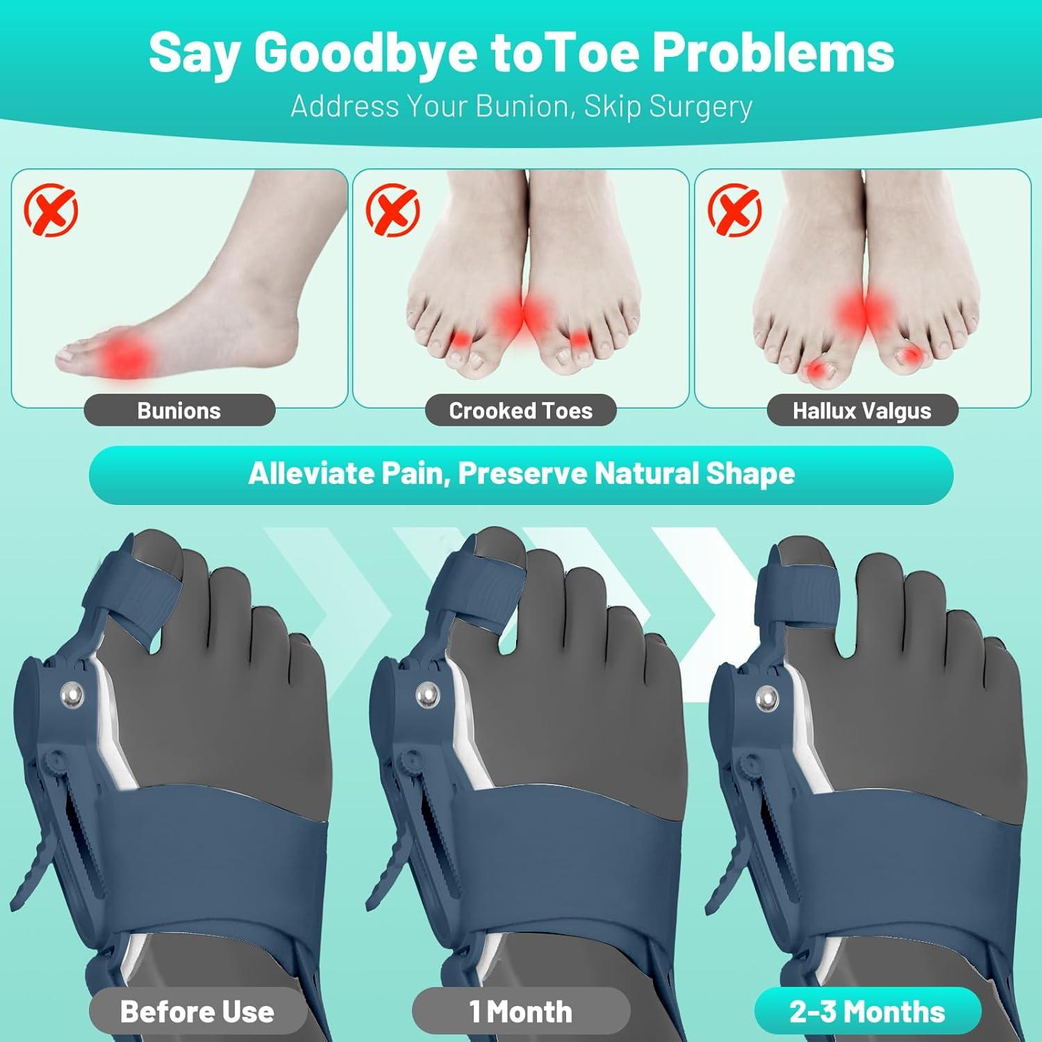 Corrector de Bunion QDAVE Ajustable para Alivio de Dolor